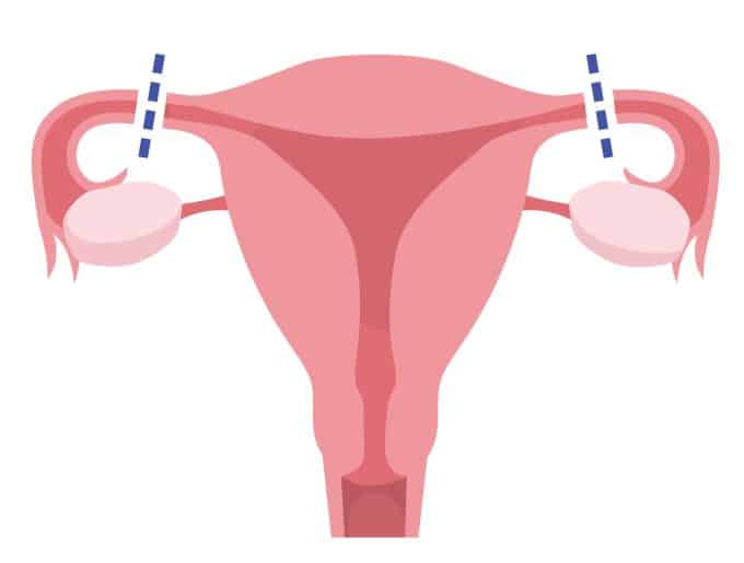 tubal-ligation-illustration